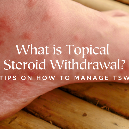 What is topical steroid withdrawal (TSW) symptoms