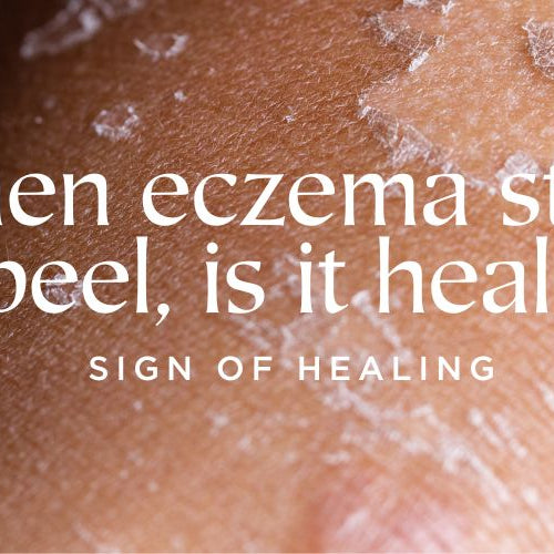 When eczema starts to peel is it healing?