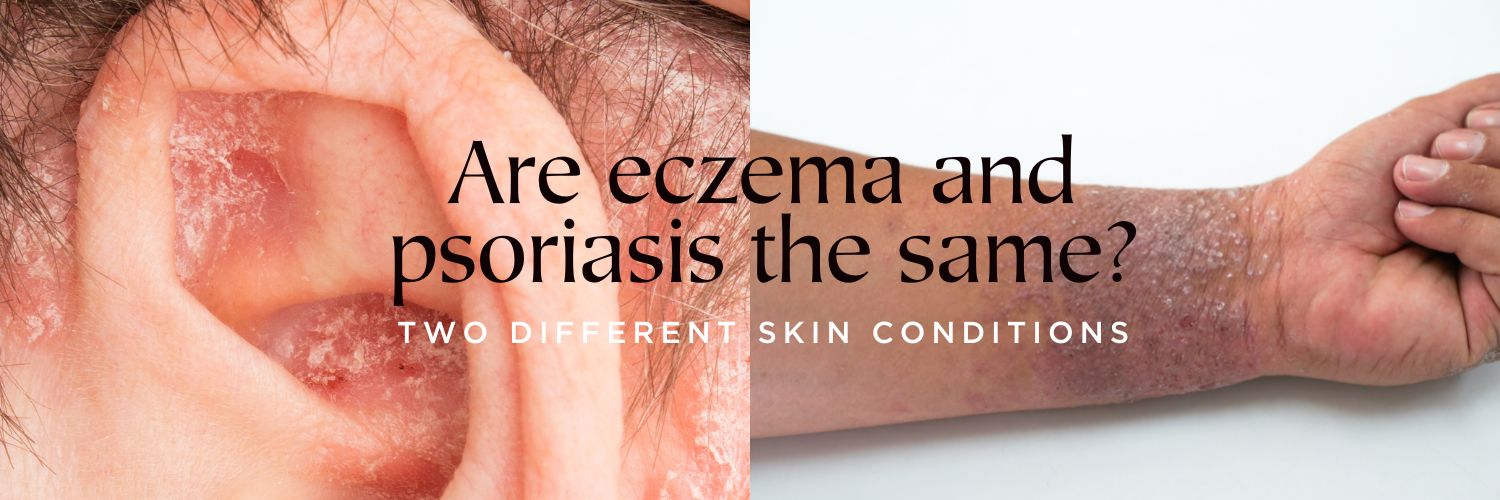 Are eczema and psoriasis the same?