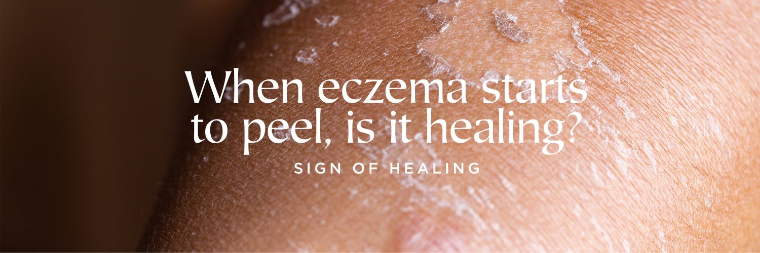 When eczema starts to peel is it healing?