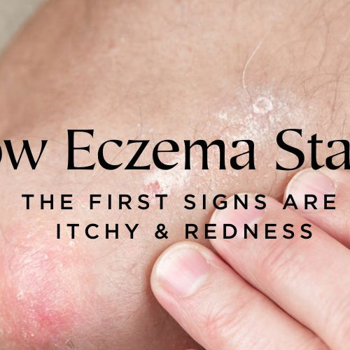 How Eczema Starts